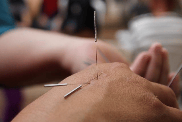 Acupuncture and Healing